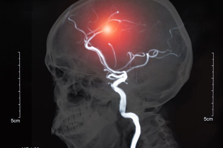 Pengobatan Aneurisma: Langkah-langkah dalam Menghadapi Ancaman Kesehatan Ini