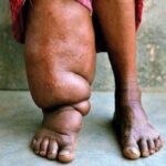 Cara Mengobati Filariasis dengan Efektif dan Aman