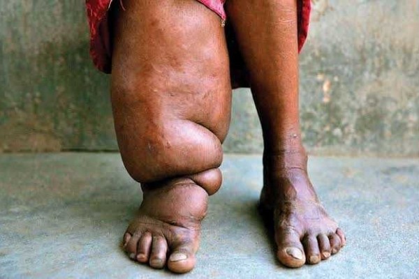 Cara Mengobati Filariasis dengan Efektif dan Aman